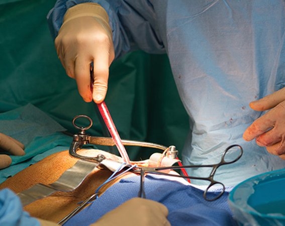 Who is Eligible for Kidney Transplant Surgery