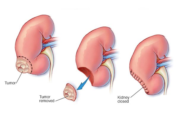What is Laparoscopic Nephrectomy