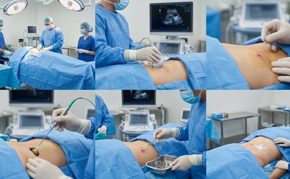 Micro Perc Procedure