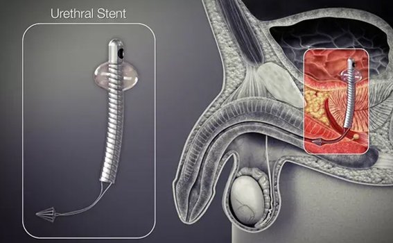 Causes of Urethral Stricture