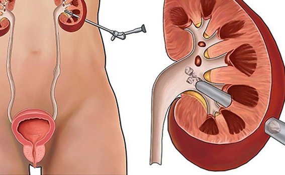 Benefits of PCNL Surgery