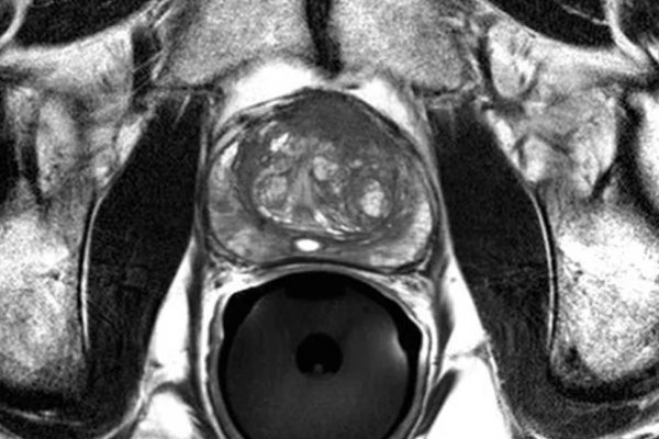 Diagnosis of Prostate Cancer