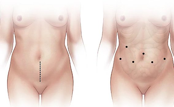 Life After Bladder Removal Surgery