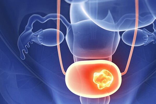 Conditions Treated with Robotic Cystectomy