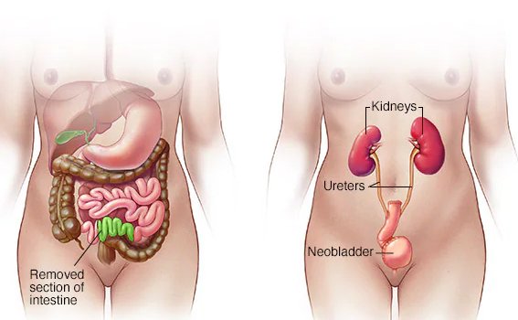 Urinary Diversion After Cystectomy