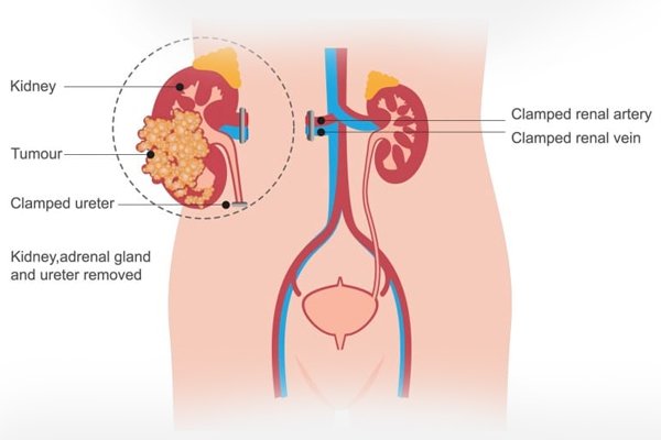 What is Robotic Radical Nephrectomy