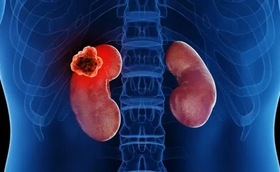 Kidney Cancer