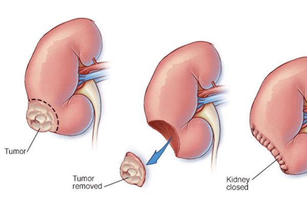 Conditions Treated with Robotic Radical Nephrectomy