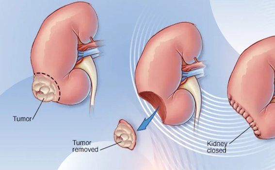 Robotic Radical Nephrectomy Procedure Steps