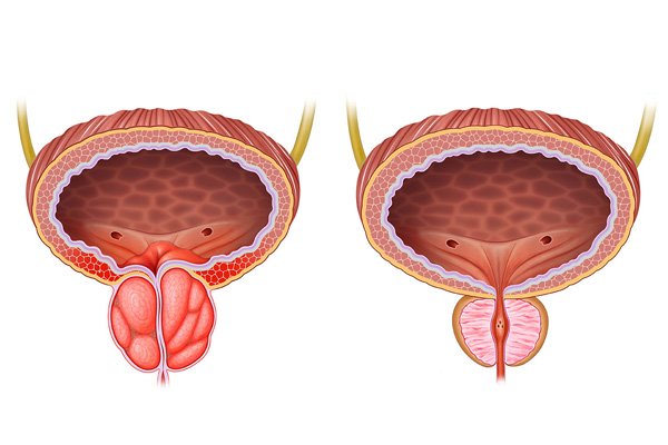Symptoms of Enlarged Prostate
