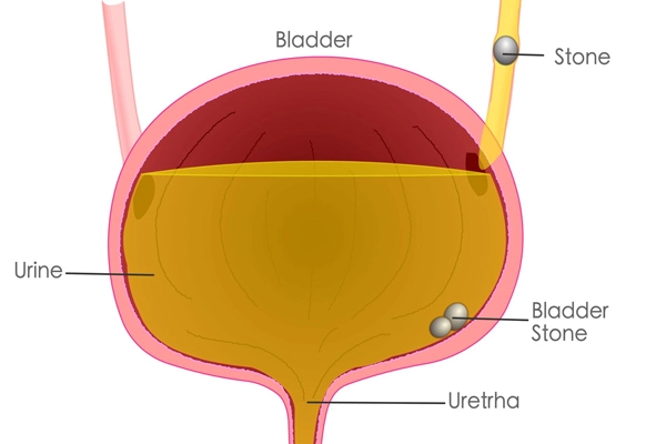 Causes of Bladder Stones