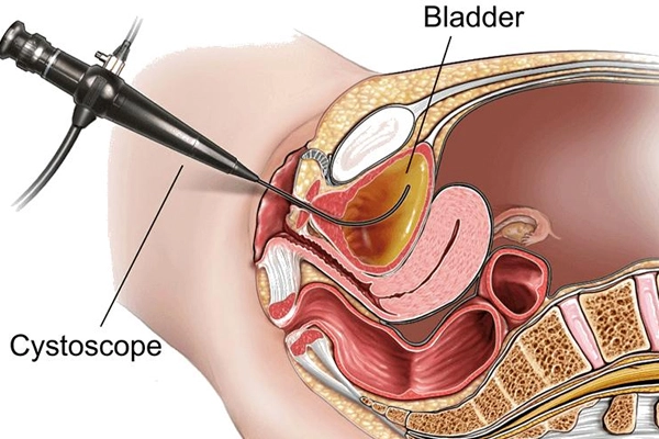 Complications of Untreated Bladder Stones