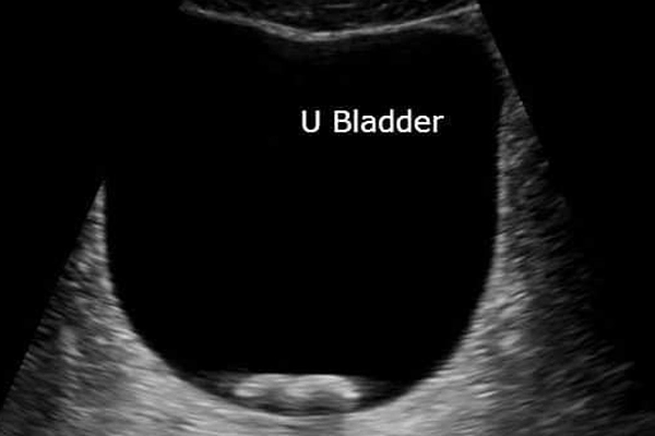 Diagnosis of Bladder Stones