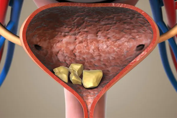 Prevention of Bladder Stones