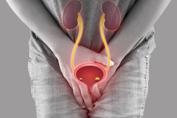 What Are Bladder Stones