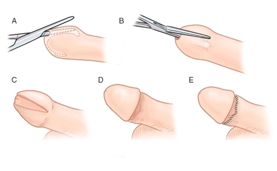 Circumcision Procedure