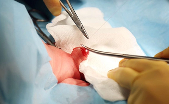 Risks & Complications of Circumcision