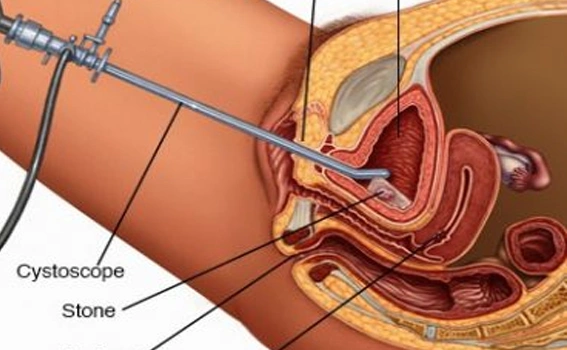 Cystolithotomy Procedure
