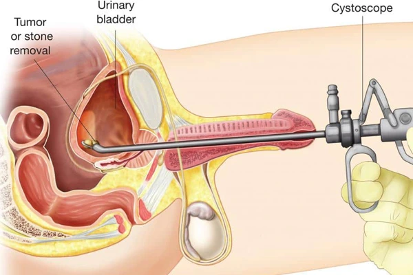Who Needs Cystolithotripsy