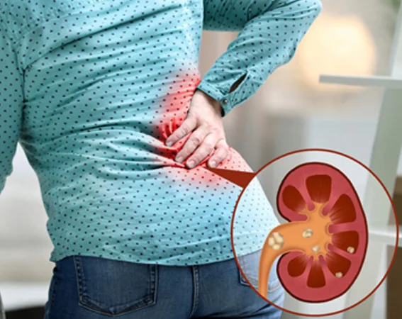 Causes of Kidney Stones