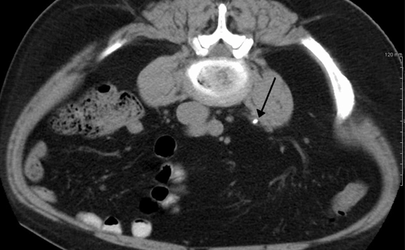 Diagnosis of Kidney Stones