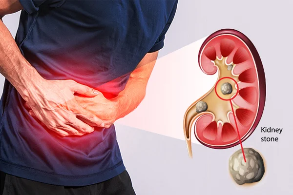 Symptoms of Kidney Stones