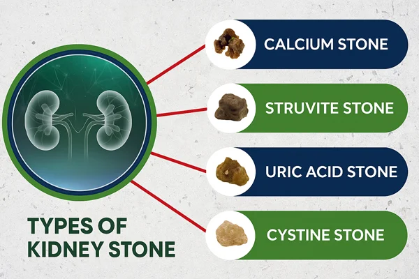 Types of Kidney Stones
