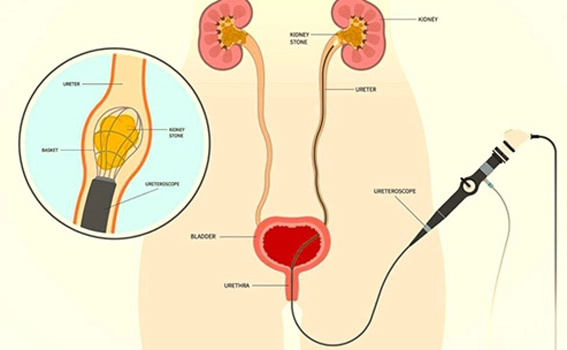 Benefits of Laser URSL Surgery