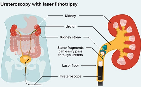 Laser URSL Procedure