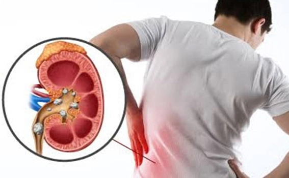 Recovery After Mini Perc