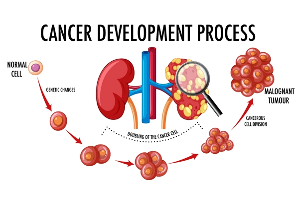 Kidney Tumors and Kidney Cancer Explained