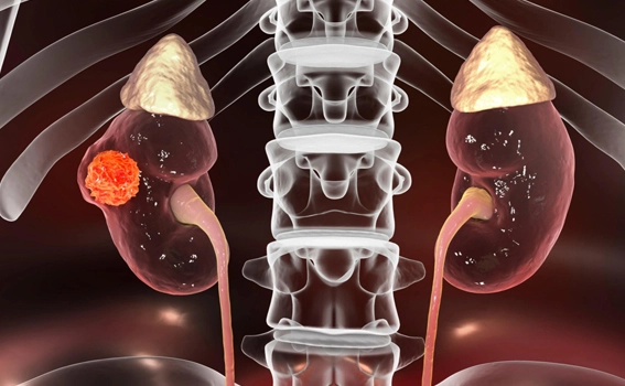 Risks & Complications of Partial Nephrectomy