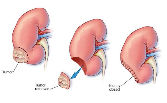 Types of Partial Nephrectomy