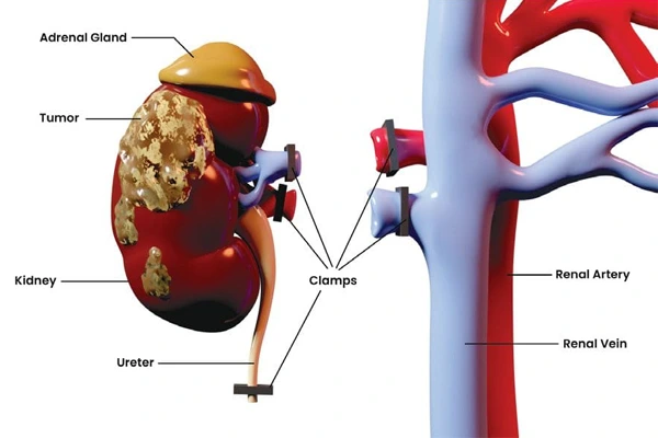 What Conditions Are Treated with Partial Nephrectomy