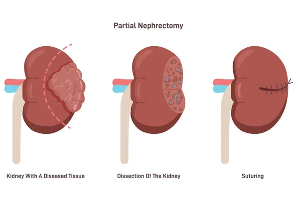 Partial Nephrectomy