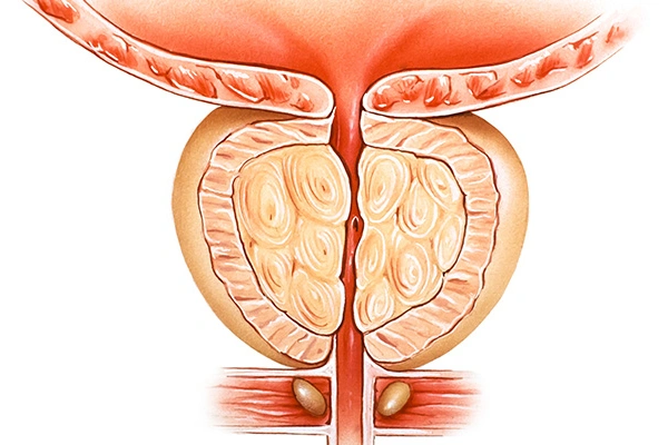 Diagnosis of Prostate Enlargement