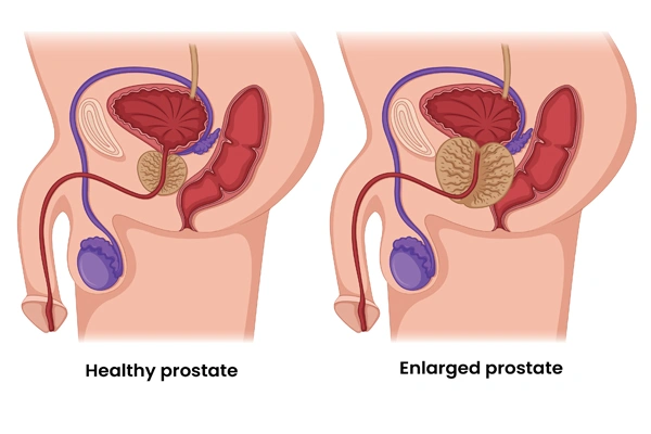 What is Prostate Enlargement (BPH)