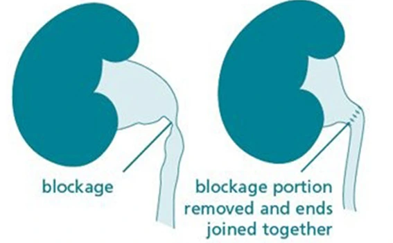 Benefits of Pyeloplasty Surgery