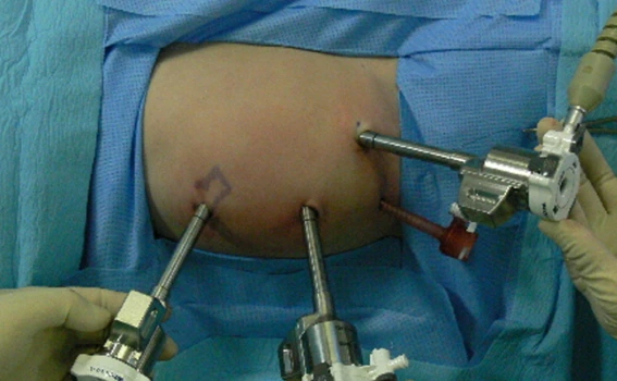 Pyeloplasty Surgery in Adults vs Children