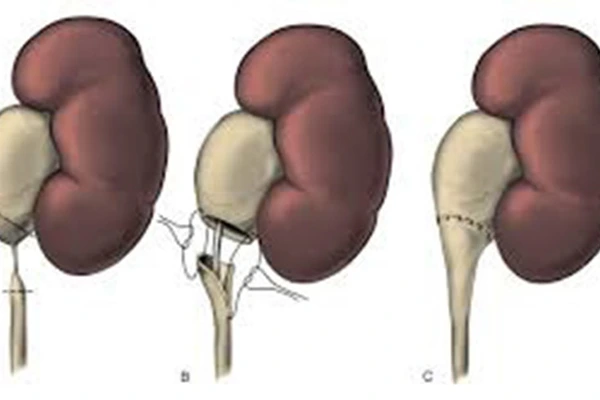 Pyeloplasty Procedure