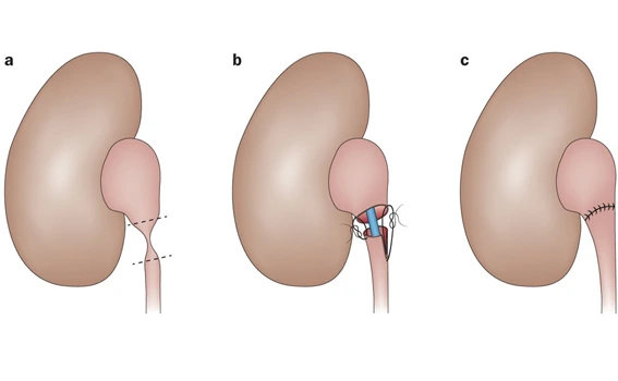Symptoms of UPJ Obstruction