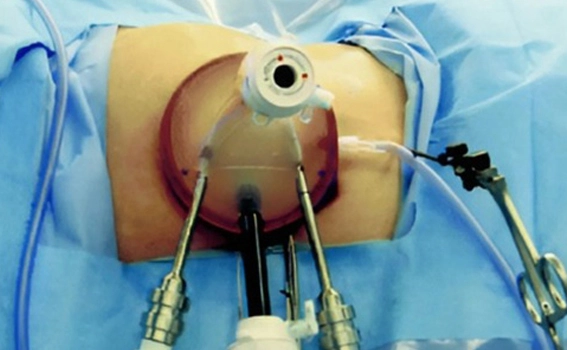 Who Needs Pyeloplasty Surgery