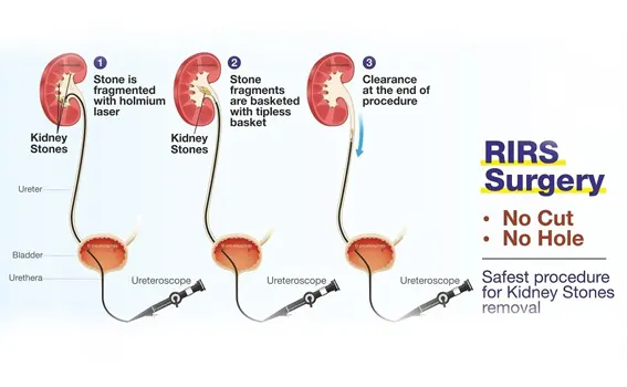 Benefits of RIRS Surgery