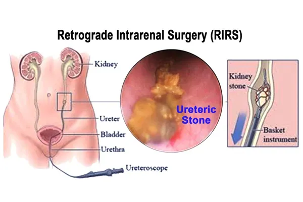 Who Needs RIRS Surgery