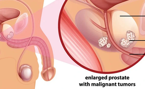 Cancer Control and Oncological Outcomes