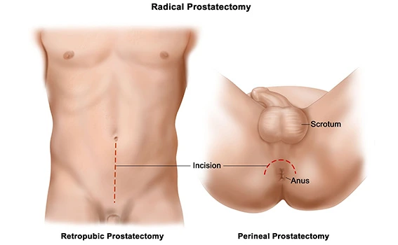 Risks & Complications of Robotic Radical Prostatectomy