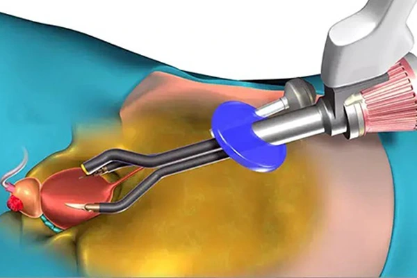 Robotic Radical Prostatectomy Procedure
