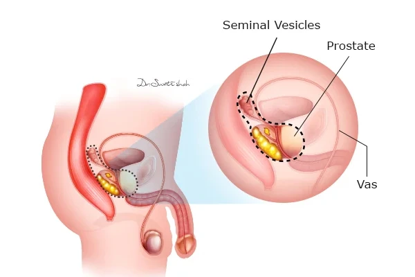Conditions for Radical Prostatectomy