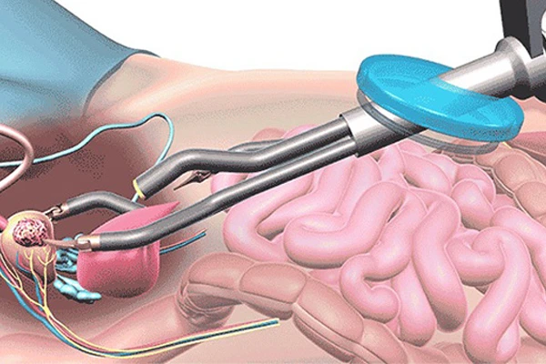Robotic Radical Prostatectomy