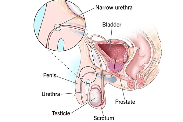 Benefits of Ureteroplasty Surgery